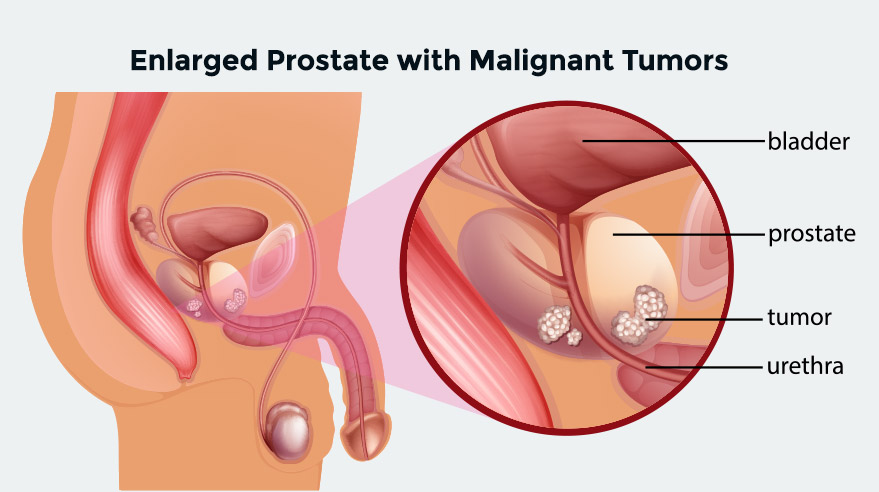 PROSTATE TUMORS