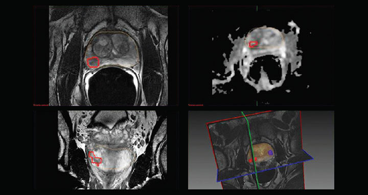特斯拉-多参数-MRI