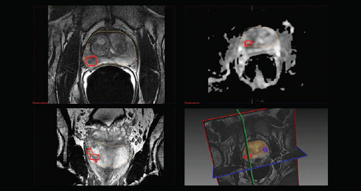 tesla-multiparamétrica-MRI